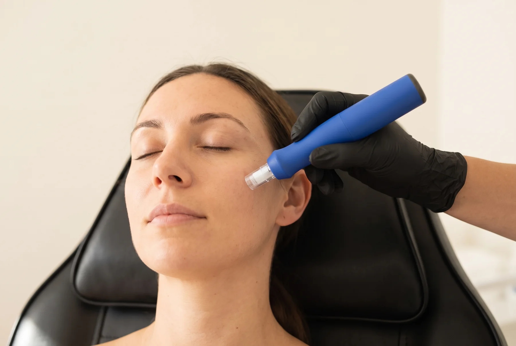 A provider guiding the SkinPen microneedling device along a patient’s cheek at the Royal Oak clinic